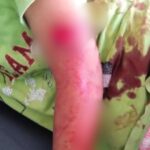 Bocah SD di Jombang menjadi korban teror monyet./bongkah.id/Karimatul Maslahah/