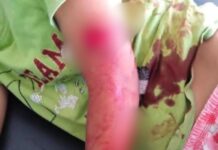 Bocah SD di Jombang menjadi korban teror monyet./bongkah.id/Karimatul Maslahah/