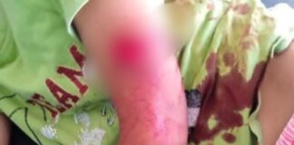 Bocah SD di Jombang menjadi korban teror monyet./bongkah.id/Karimatul Maslahah/